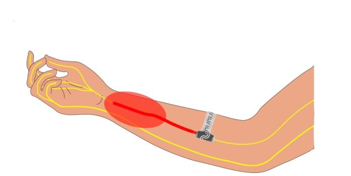 Implantable device manages pain on demand